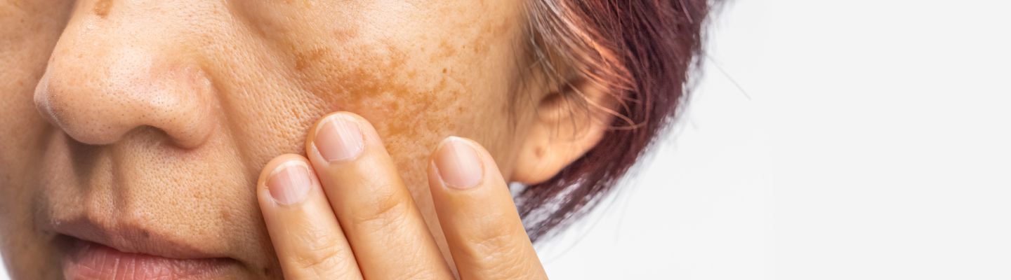 Ādas pigmenu likvidācija Rīga, Āgenskalns